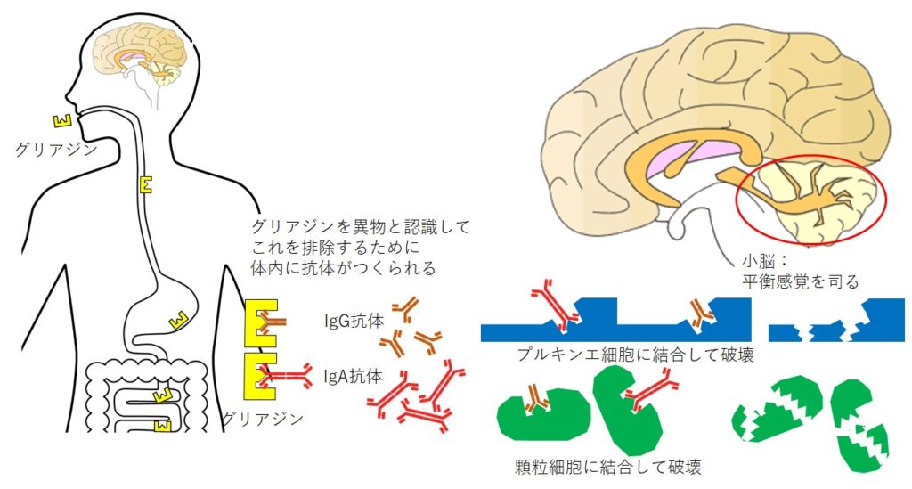 グルテン失調症